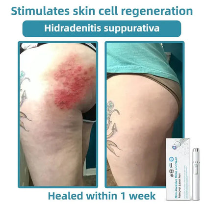 Jilvax™ ClearSkin Pen